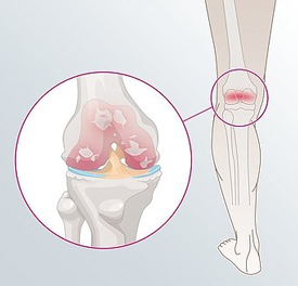 Osteoartritída kolena